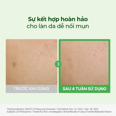Tinh Chất Cấp Ẩm Và Hỗ Trợ Làm Dịu Cho Da Mụn Torriden Balanceful Centella Asiatica Extract Serum 50ml