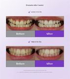  Set Kem Đánh Răng Euthymol Purple Whitening Toothpaste 106g + Tuýp Mini 30g + 3 Gói Nước Súc Miệng 