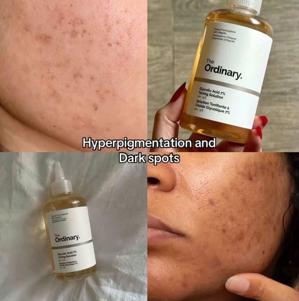 Nước hoa hồng The Ordinary Glycolic Acid 7% Toning Solution pH~3.6 Chai 240ml