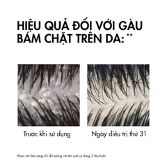 DẦU GỘI GIẢM GÀU CHO DA ĐẦU, DẦU, NGỨA VICHY DERCOS SHAMPOO 50ML