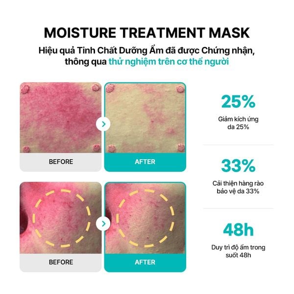 Mặt nạ dưỡng ẩm Rejuran Moisture Treatment Mask: Cứu cánh cấp tốc cho làn da khô ráp và kích ứng