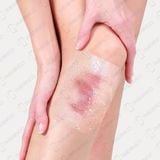 Băng vô trùng không gạc trong suốt không thấm nước Sterile Adflex (Non-Pad) 10cmx12cm