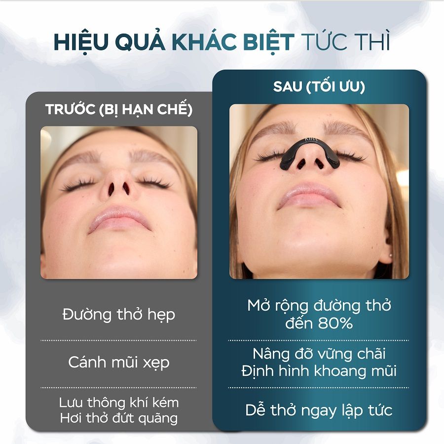  Miếng dán nong mũi hỗ trợ đường thở KIRA BrEASY 