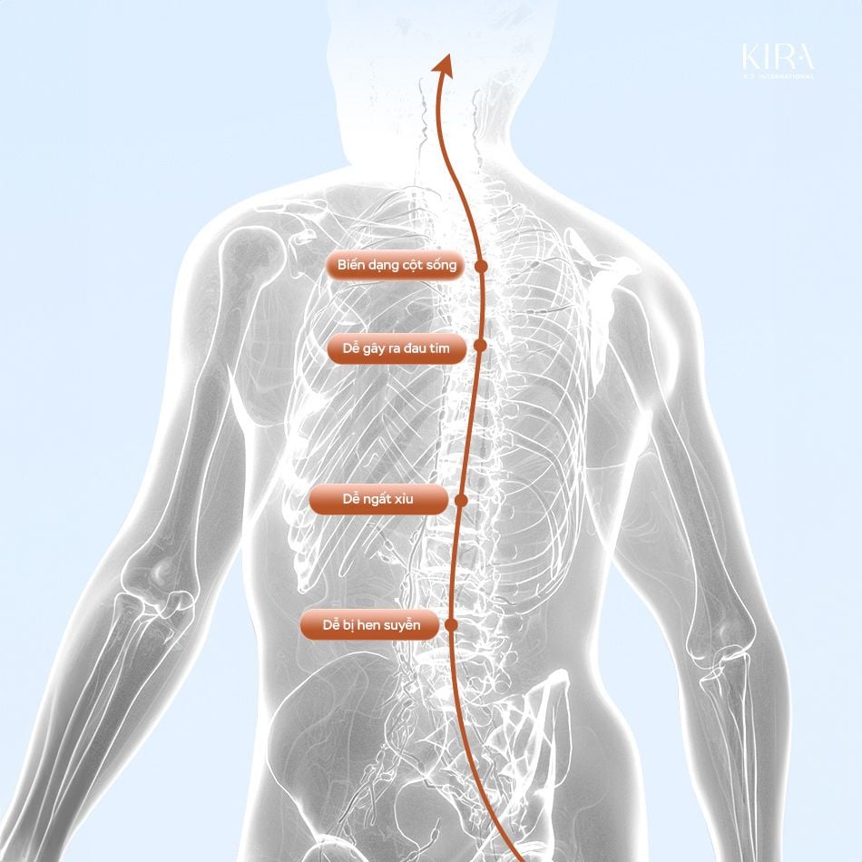  Đai chống gù thông minh cho bé – Bản X có cảm biến rung theo dõi tư thế 