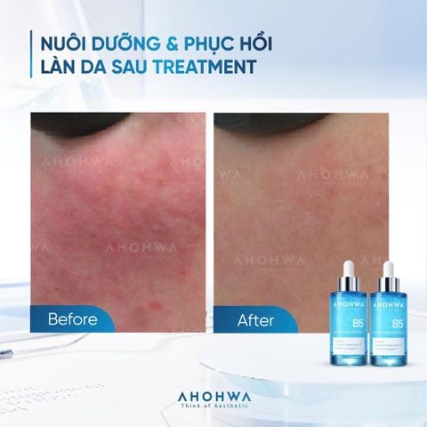  Hydration Ampoule B5 - Tinh Chất B5 Hỗ Trợ Cấp Ẩm Và Chăm Sóc Da Khỏe Mạnh - 30ml 