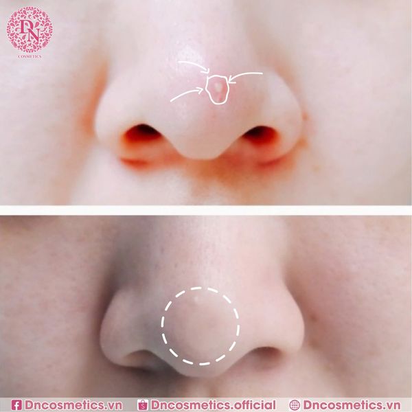 MIẾNG DÁN MỤN SOME BY MI CLEAR SPOT PATCH