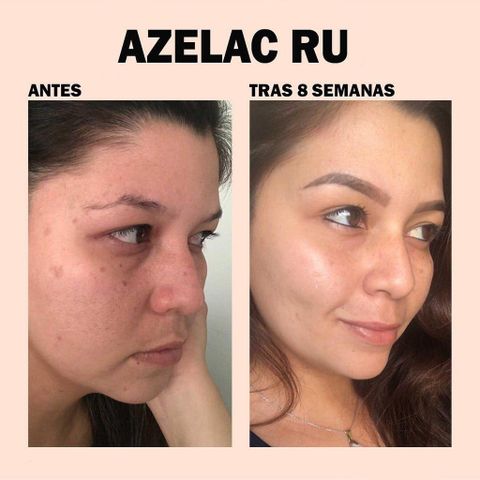 Sesderma Azelac RU Liposomal Serum 30ml – Serum Làm Sáng Da, Cải Thiện Sạm Nám & Da Không Đều Màu