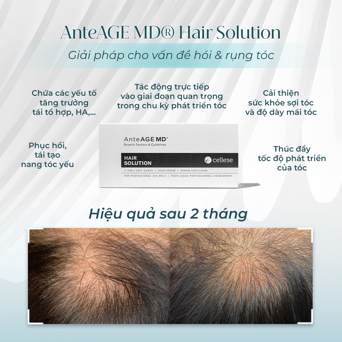AnteAGE MD Hair Solution - Tinh Chất Giảm Rụng Và Kích Thích Mọc Tóc