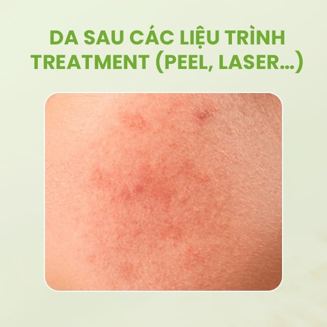 Sesderma Hidraloe Aloe Gel 250ml – Gel Lô Hội Làm Dịu & Phục Hồi Da Nhanh
