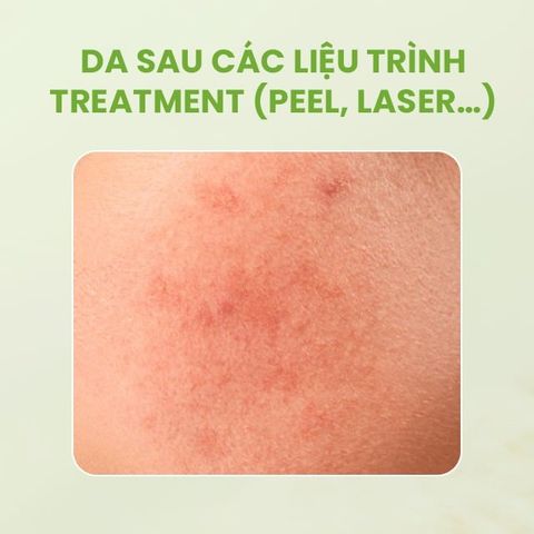 Sesderma Hidraloe Aloe Gel 250ml – Gel Lô Hội Làm Dịu & Phục Hồi Da Nhanh