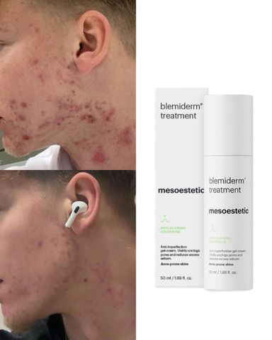 Mesoestetic Blemiderm Treatment Tinh Chất Hỗ Trợ Giảm Mụn Và Kiểm Soát Dầu 50ml