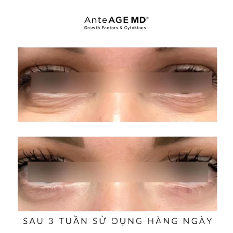 AnteAGE EYE Reset Biosomes - Kem Mắt  Hỗ Trợ Giảm Bọng, Thâm, Nếp Nhăn Vùng Mắt 15ml