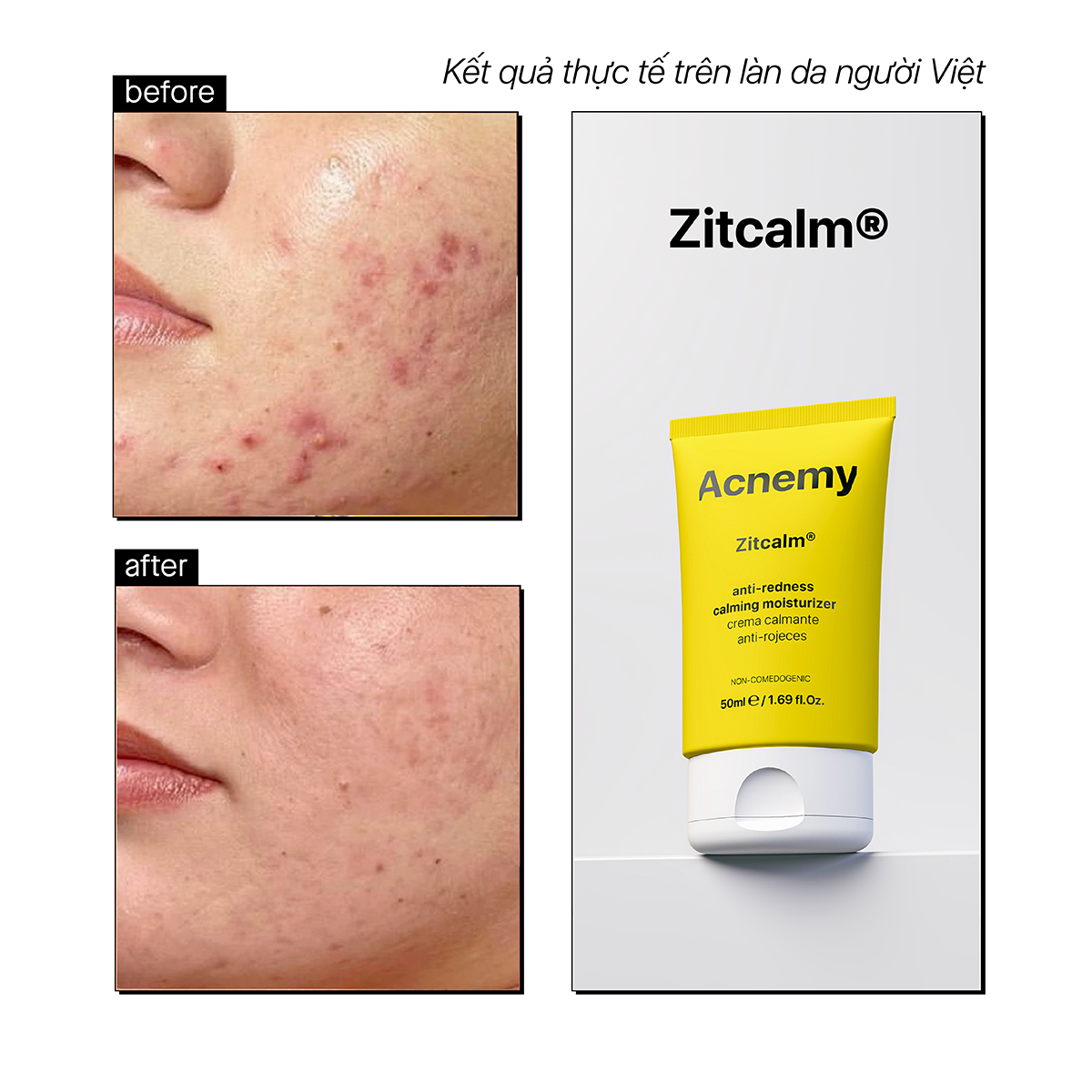 Acnemy Zitcalm Anti Redness Calming Moisturizer Kem Dưỡng Làm Dịu Da Và Hỗ Trợ Phục Hồi Da 50ml