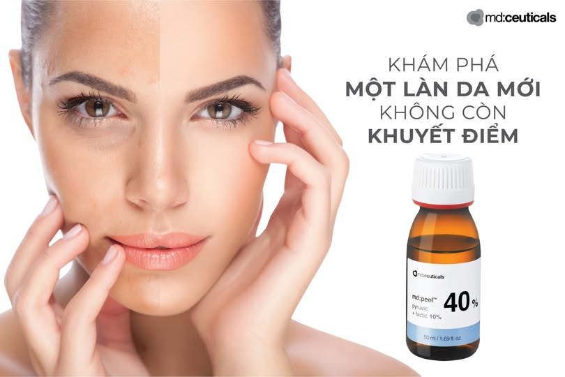 Md:ceuticals MD:Peel Pyruvic 40% + Lactic 10%- Thay Da Sinh Học Mụn Mức Độ 3,4 Chống Lão Hóa Với Axit Pyruvic 40% + Latic 10%