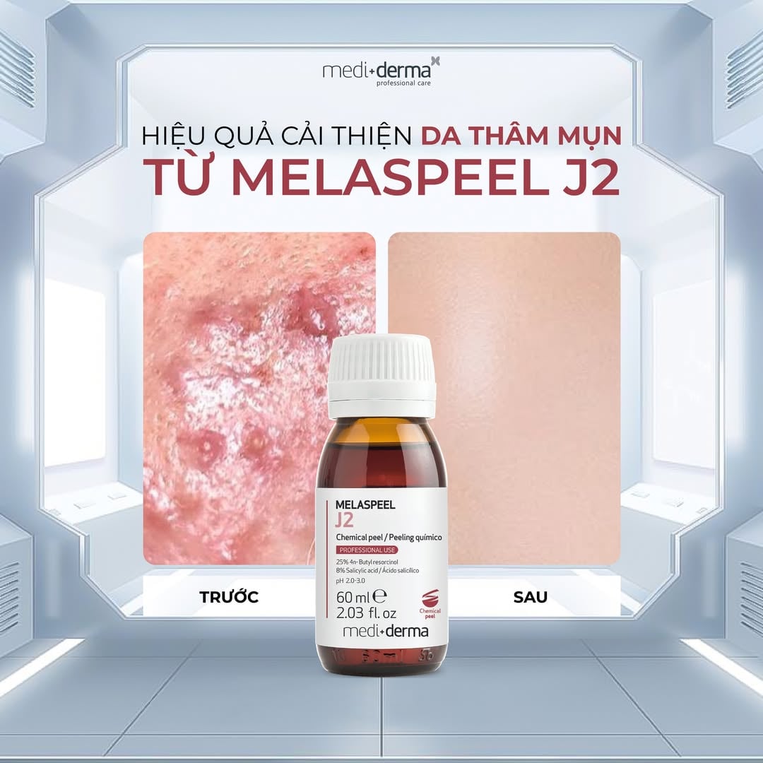 Mediderma Melaspeel J2 - Dung Dịch Peel Giảm Mụn, Sẹo Mụn Và Cải Thiện Sắc Tố 60ml