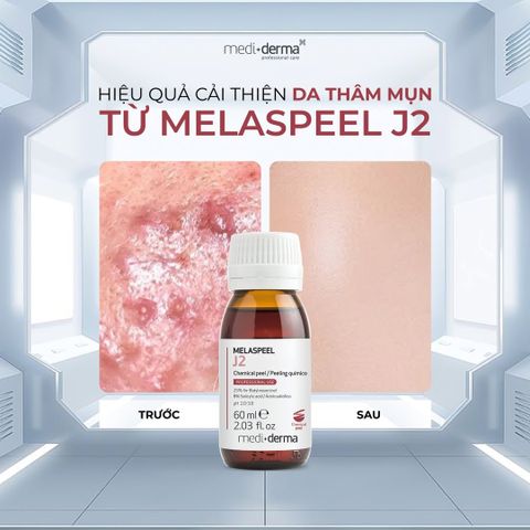 Mediderma Melaspeel J2 - Dung Dịch Peel Giảm Mụn, Sẹo Mụn Và Cải Thiện Sắc Tố 60ml