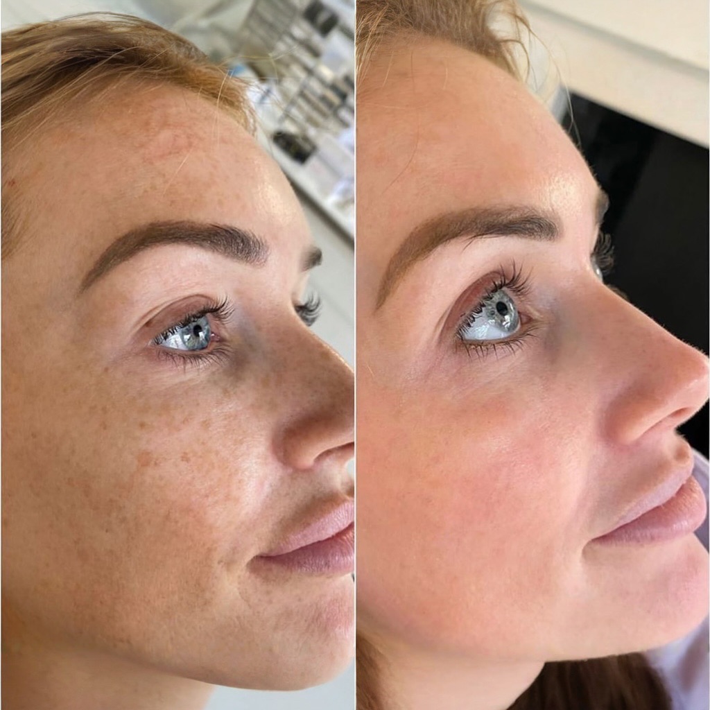 Mesoestetic Cosmelan 1 - Kem Hỗ Trợ Giảm Nám Da 15g
