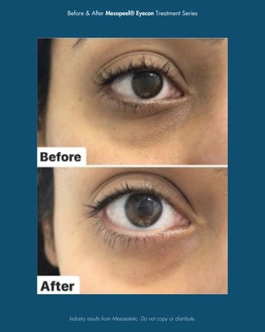 Mesoestetic Mesopeel Eyecon Peel Hỗ Trợ Cải Thiện Quầng Thâm, Nếp Nhăn Vùng Da Quanh Mắt 50ml