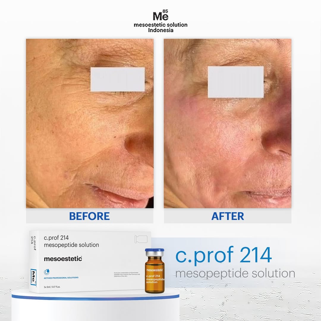 Mesoestetic C.Prof 214 Mesopeptide Solution - Tinh Chất Hỗ Trợ Tăng Sinh Collagen, Săn Chắc Da Và Tăng Độ Đàn Hồi Da 5x5ml