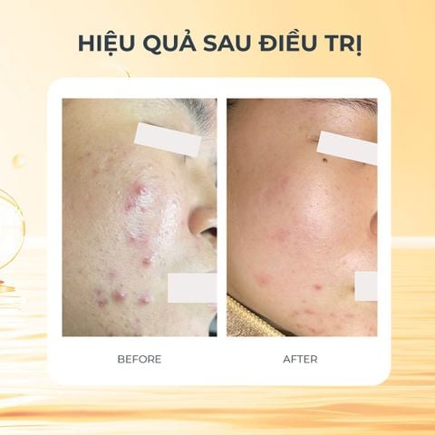 Mediderma Salipeel LIC Nano Additive Xịt Peel Tăng Cường Giảm Viêm Và Giảm Mụn