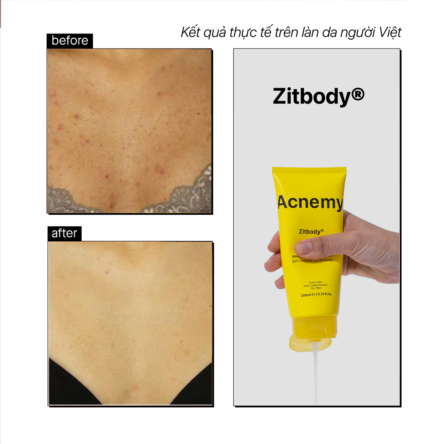 Acnemy Zitbody Clarifying Body Wash Sữa Tắm Làm Sạch Da Và Hỗ Trợ Làm Giảm Mụn Body 200ml