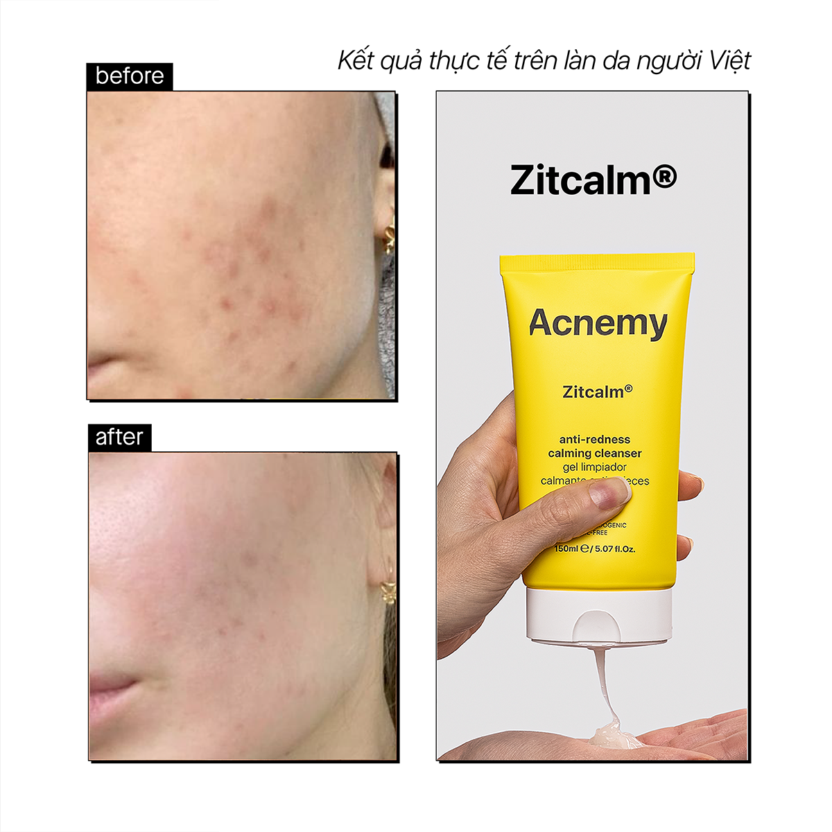 Acnemy Zitcalm Anti Redness Calming Cleanser Gel Rửa Mặt Làm Dịu Da Và Hỗ Trợ Làm Sạch Nhẹ Nhàng 150ml