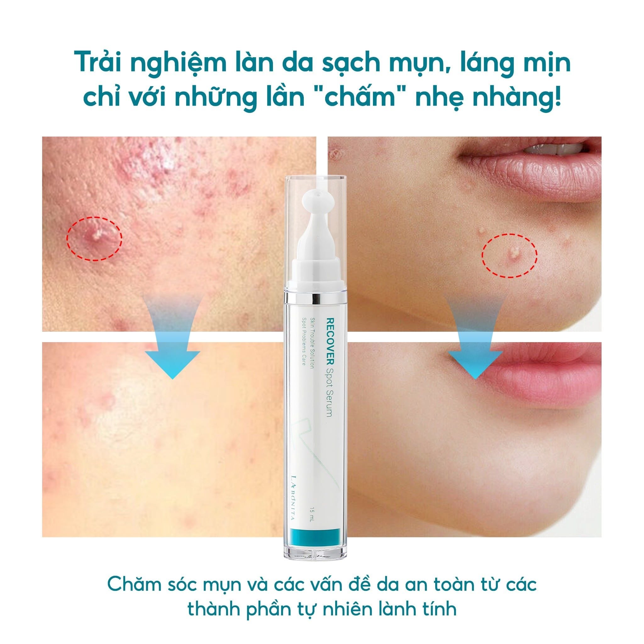  Tinh Chất Chấm Mụn Hỗ Trợ Giảm Mụn Sưng Viêm - Labonita Recover Spot Serum 