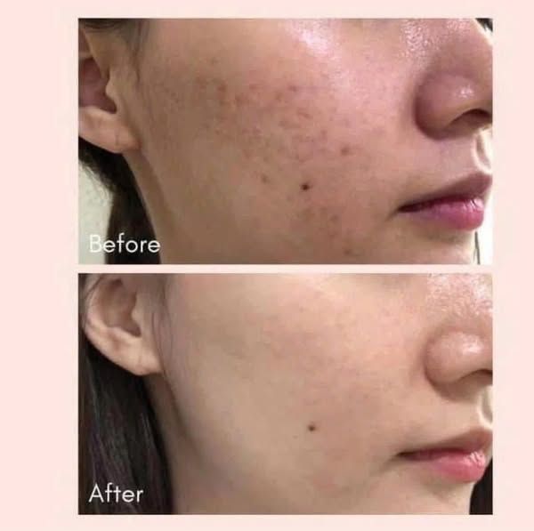 [Tem LG ] Cao Trị Nám Dưỡng Trắng WHOO Radiant White Ultimate Corrector 20ml