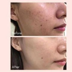 [Tem LG ] Cao Trị Nám Dưỡng Trắng WHOO Radiant White Ultimate Corrector 20ml