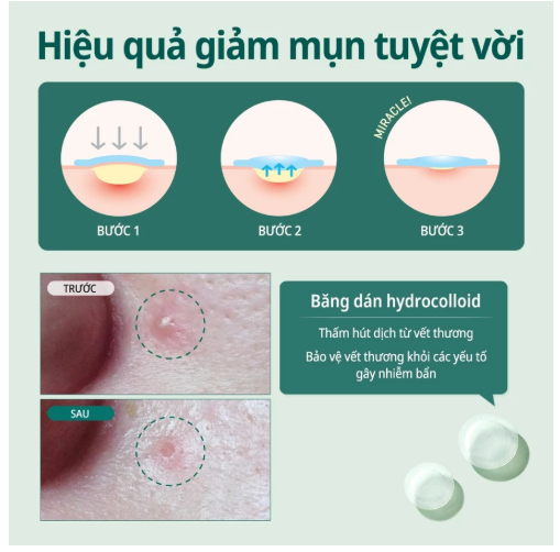Miếng Dán Mụn Some By Mi Clear Spot Patch
