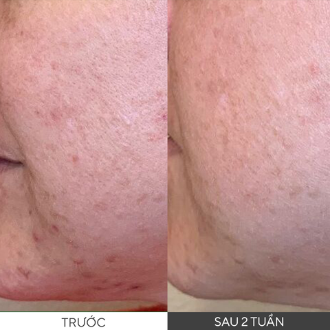 [SALE 30%] Dung dịch tẩy tế bào chết hóa học, thông thoáng lỗ chân lông Murad Daily Clarifying Peel 95ml