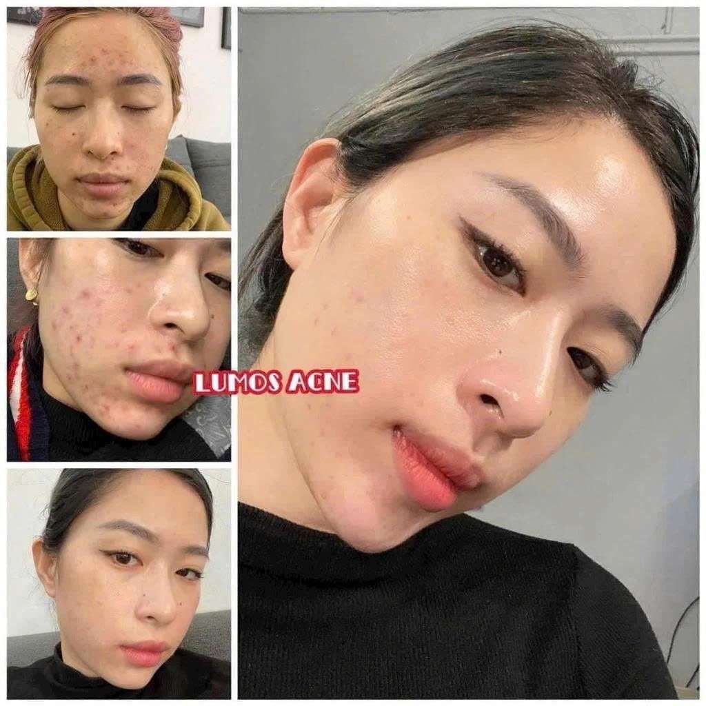  Serum trị Mụn Lumos Acne BKCOKR-9108 