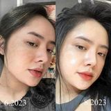  Kem Trị Nám Nadomi BKCOKR-9063 