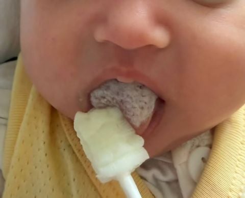 LƯỠI TRẮNG Ở TRẺ NHỎ: PHÂN BIỆT CẶN SỮA – TƯA MIỆNG – TỔN THƯƠNG NIÊM MẠC MIỆNG