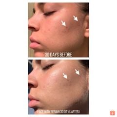 The Ordinary Niacinamide 10% + Zinc 1% giảm mụn,giảm thâm 30ml