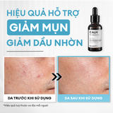  Serum Calm giảm mụn & làm dịu da 30ml 