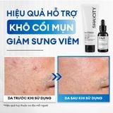  Combo giảm mụn sưng viêm Acne Duo 