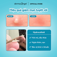 Miếng Dán Mụn Derma Angel Acne Patch