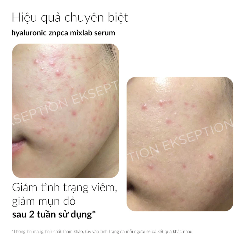 Tinh Chất Giảm Mụn Ekseption Hyaluronic ZnPCA Mixlab Serum Kiểm Soát Dầu 75ml