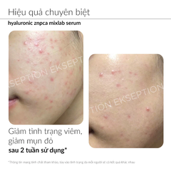 Tinh Chất Giảm Mụn Ekseption Hyaluronic ZnPCA Mixlab Serum Kiểm Soát Dầu 75ml