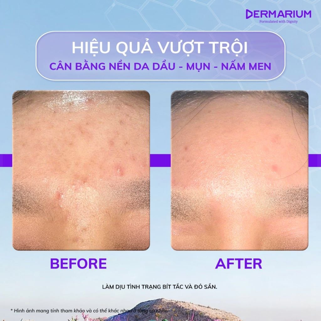 CHĂM DA MỤN