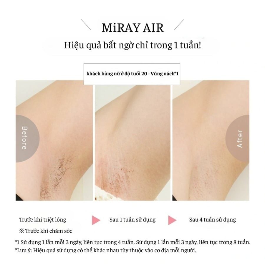 Máy triệt lông Mytrex Miray Air