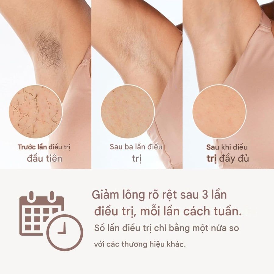 Máy triệt lông Philips Lumea IPL Series 8000 BRI945/00 với 2 đầu triệt