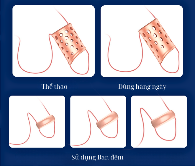 Vòng đeo Cock Rings kéo dài thời gian chống hẹp bao quy đầu, gia tăng khoái cảm