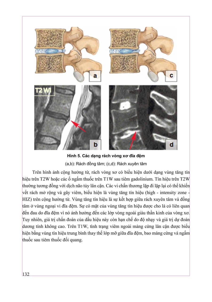 Chẩn Đoán Hình Ảnh Cơ Xương Khớp Tập 1 - PGS.TS.BS Nguyễn Duy Hùng
