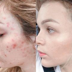 Gel Chấm Mụn Klenzit Ms Aqueous 15g