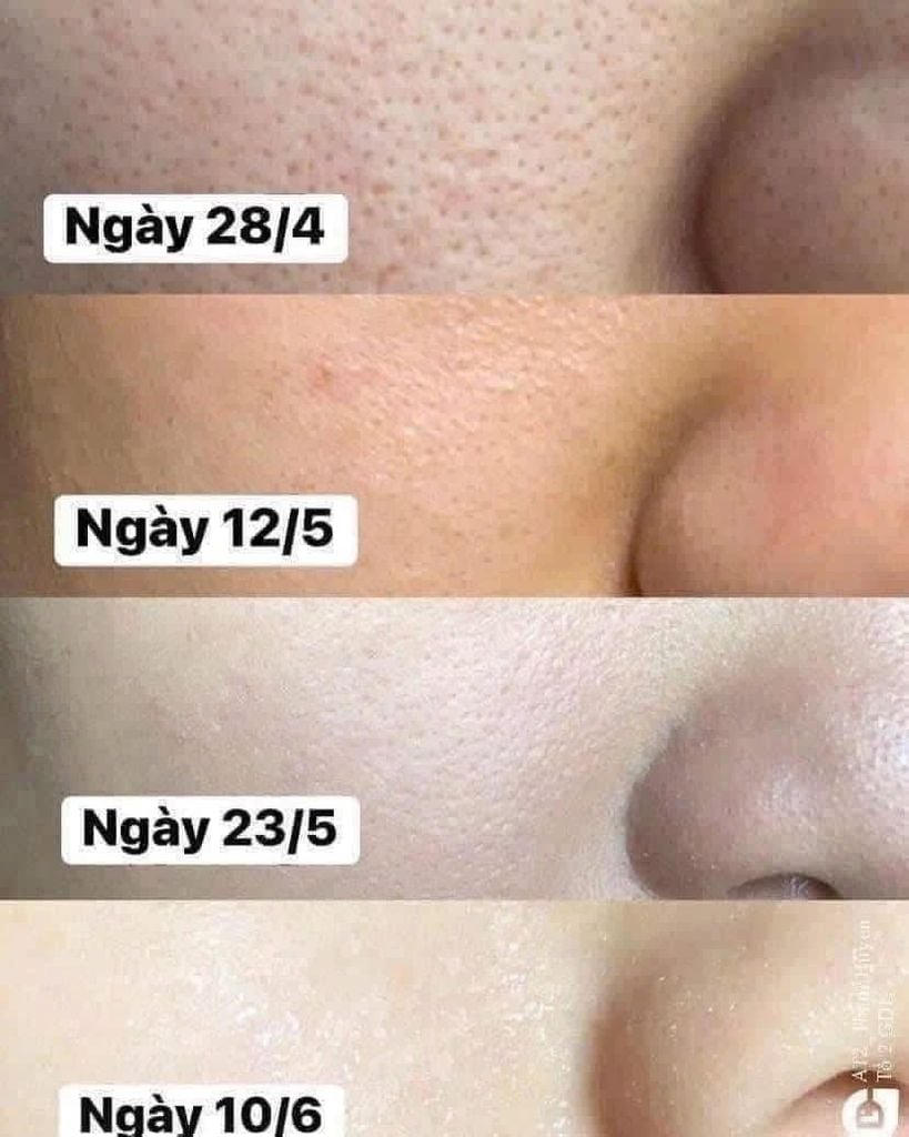 Dung Dịch Obagi Clenziderm M.D Pore Therapy Exfoliating BHA Toner 148ml (Mới-Ko Tđ)