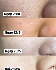 Dung Dịch Obagi Clenziderm M.D Pore Therapy Exfoliating BHA Toner 148ml (Mới-Ko Tđ)