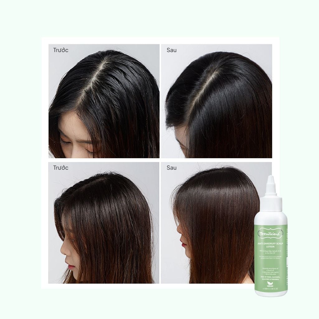 Sữa Dưỡng Ẩm Da Đầu Teenilicious Anti Dandruff Scalp Lotion – Hỗ Trợ Giảm Gàu Và Nuôi Dưỡng Tóc Mềm Mượt – 100ml