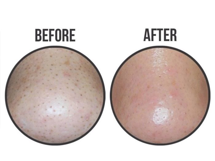 Mặt Nạ Lột Mụn Đầu Đen Ciracle Goodbye Blackhead Mask 5ml